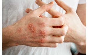 FDA Approves Tapinarof, Psoriasis in Adults